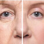 Qué es la cirugía de párpados caídos