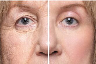 Qué es la cirugía de párpados caídos