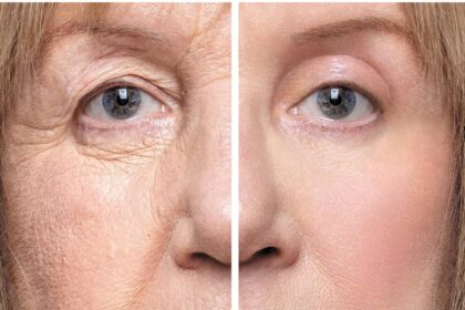 Qué es la cirugía de párpados caídos