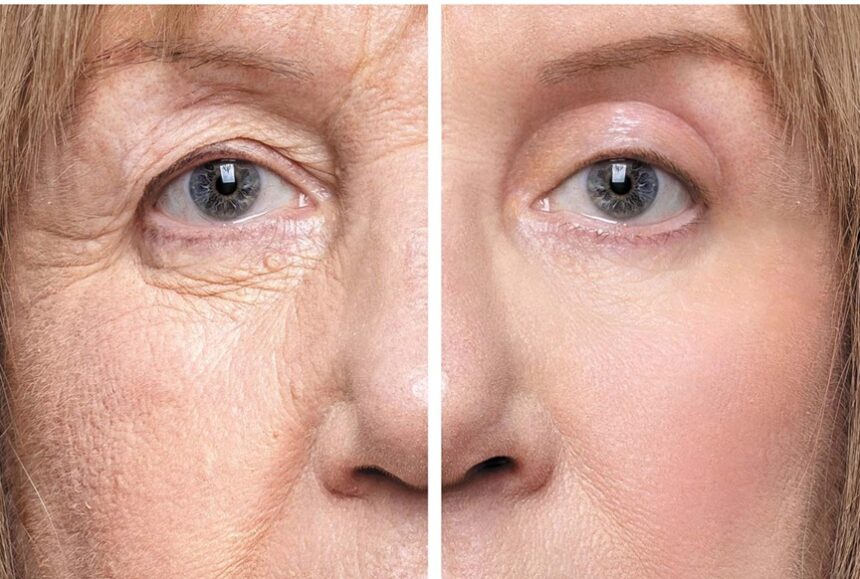Qué es la cirugía de párpados caídos