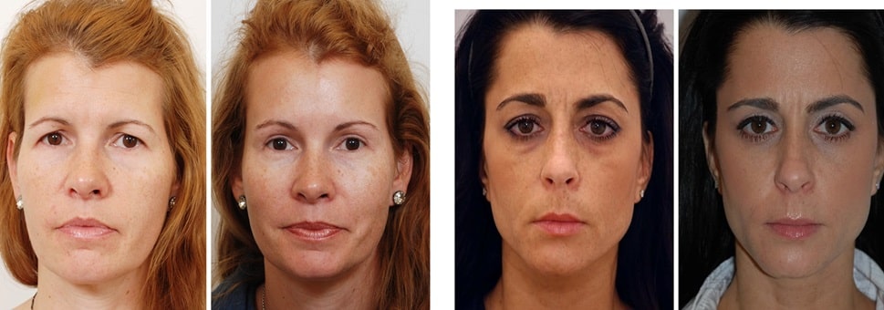 candidatos para la blefaroplastia